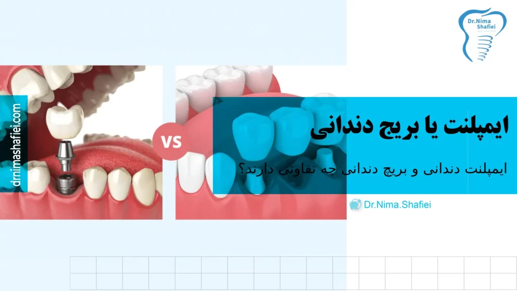 تفاوتی ایمپلنت دندانی و بریج دندانی